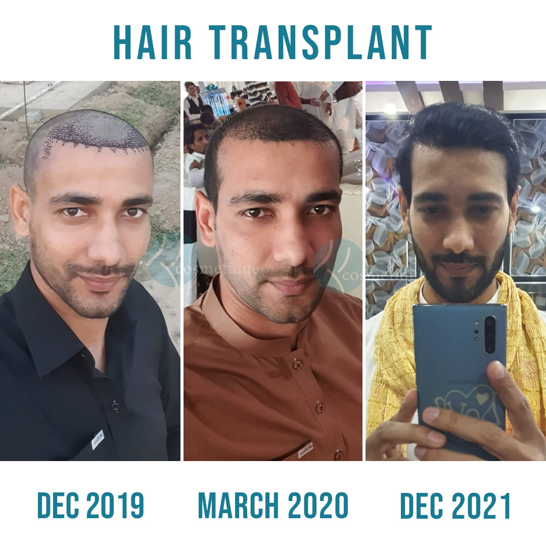 3-Hair-Transplant.jpg