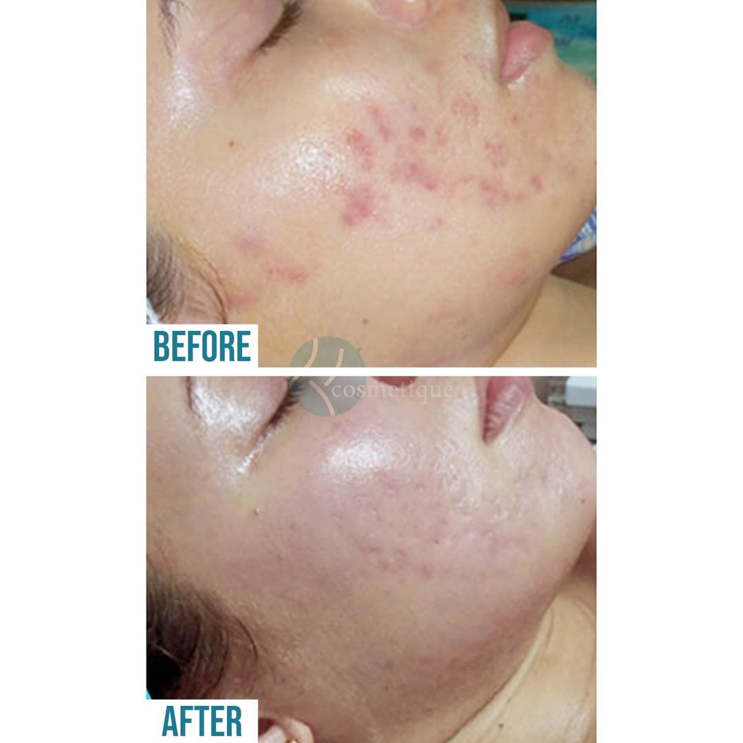 Acne Treatment At Institute Cosmetique