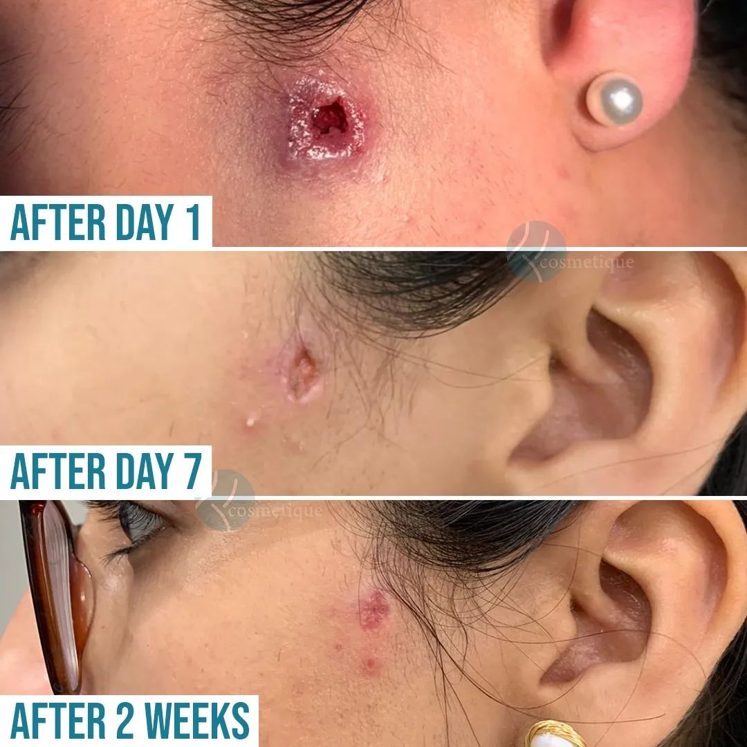Cyst Treatment At Institute Cosmetique